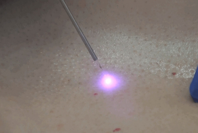 Красные родинки на теле: причины появления, опасность и необходимость удаления